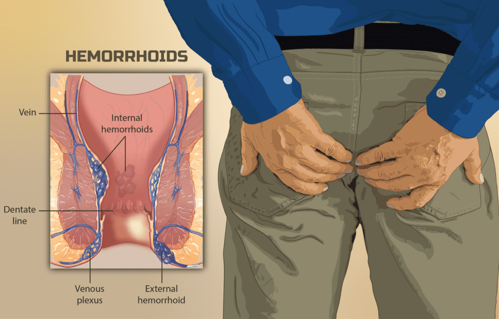Choosing Hemorrhoid Treatment for Lasting Comfort and Emotional Well-Being 2 image 4