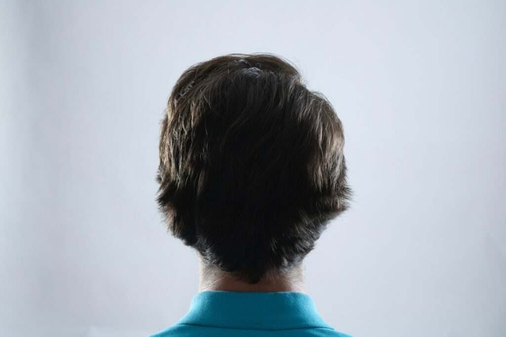 How Long Do Hair Transplants Last? 2 The back of a man's head in a blue shirt